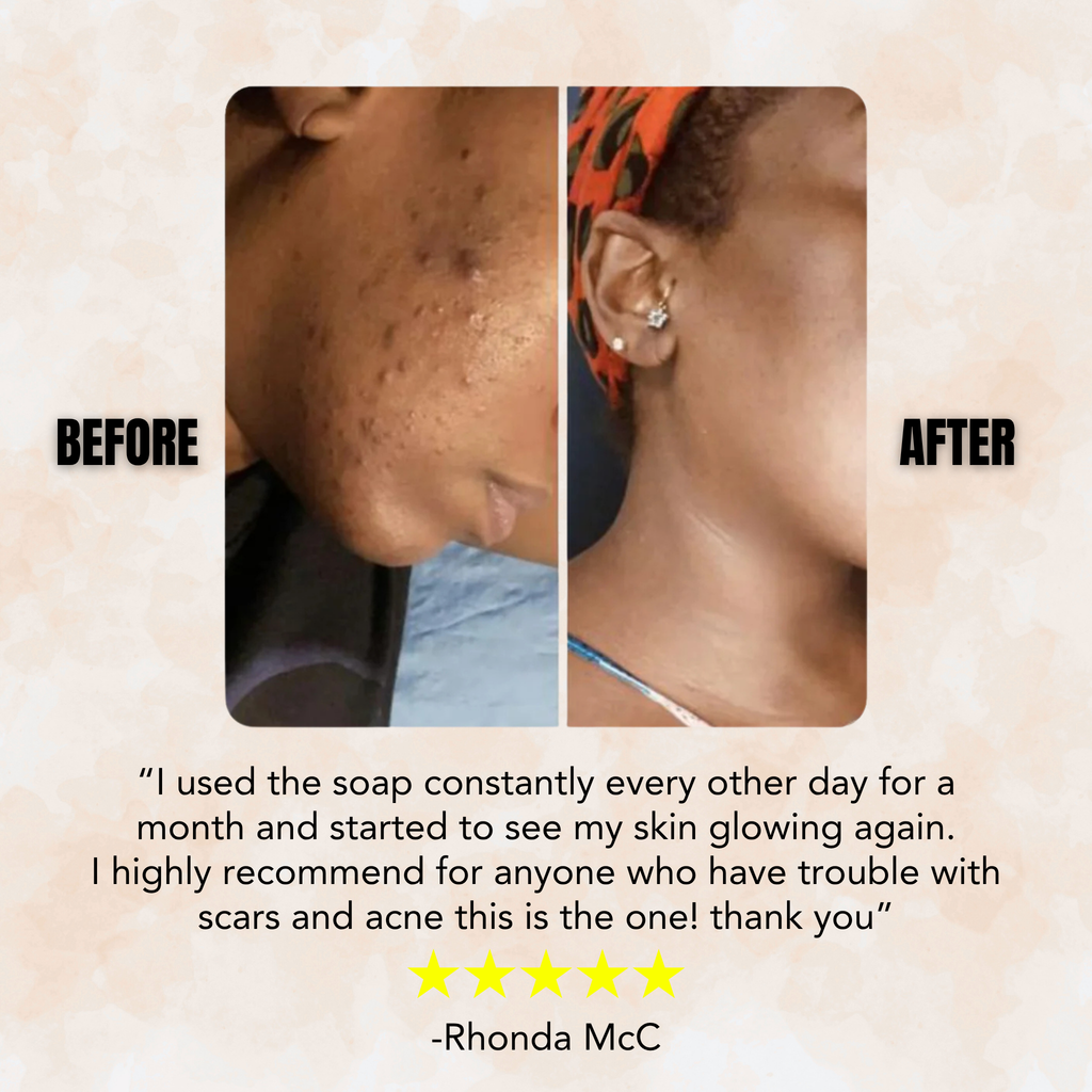 Turmeric & Kojic Acid - Skin Brightening Soap