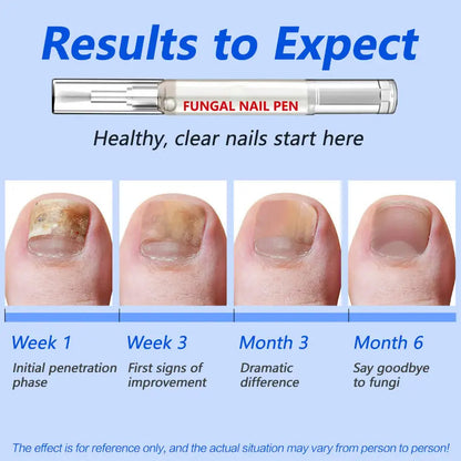 Fungal Nail Repair Pen – Clinically Effective with Allicin & Undecylenic Acid for Healthy Nails!
