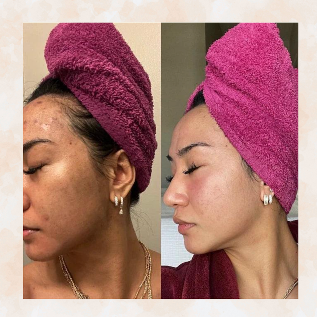 Turmeric & Kojic Acid - Skin Brightening Soap