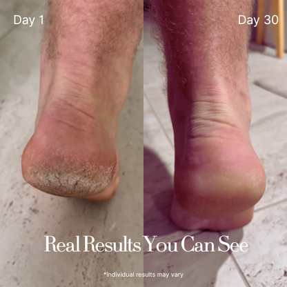 Dermatologist Recommended: Intensive Foot cream