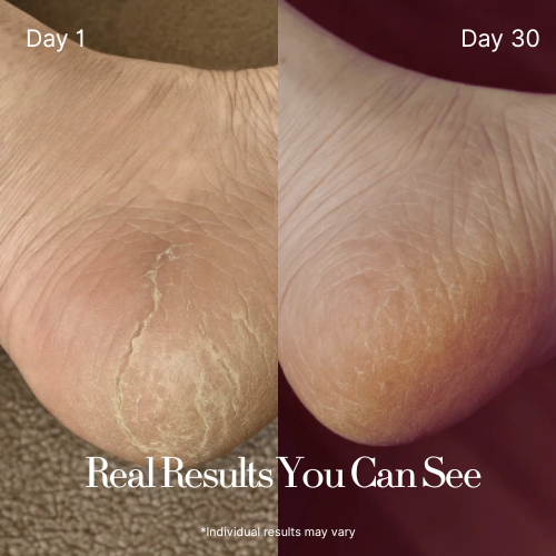 Dermatologist Recommended: Intensive Foot cream