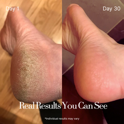 Dermatologist Recommended: Intensive Foot cream