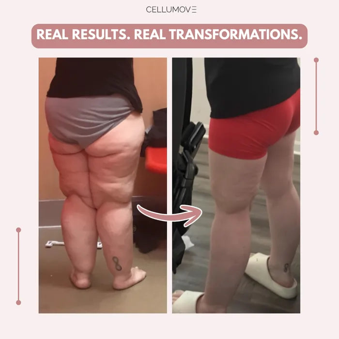 3D Legging – Say goodbye to lipoedema pain and swelling naturally