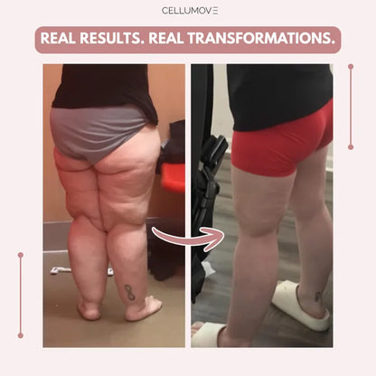 3D Legging – Say goodbye to lipoedema pain and swelling naturally