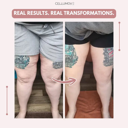 3D Legging – Say goodbye to lipoedema pain and swelling naturally