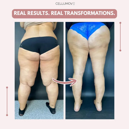 3D Legging – Say goodbye to lipoedema pain and swelling naturally