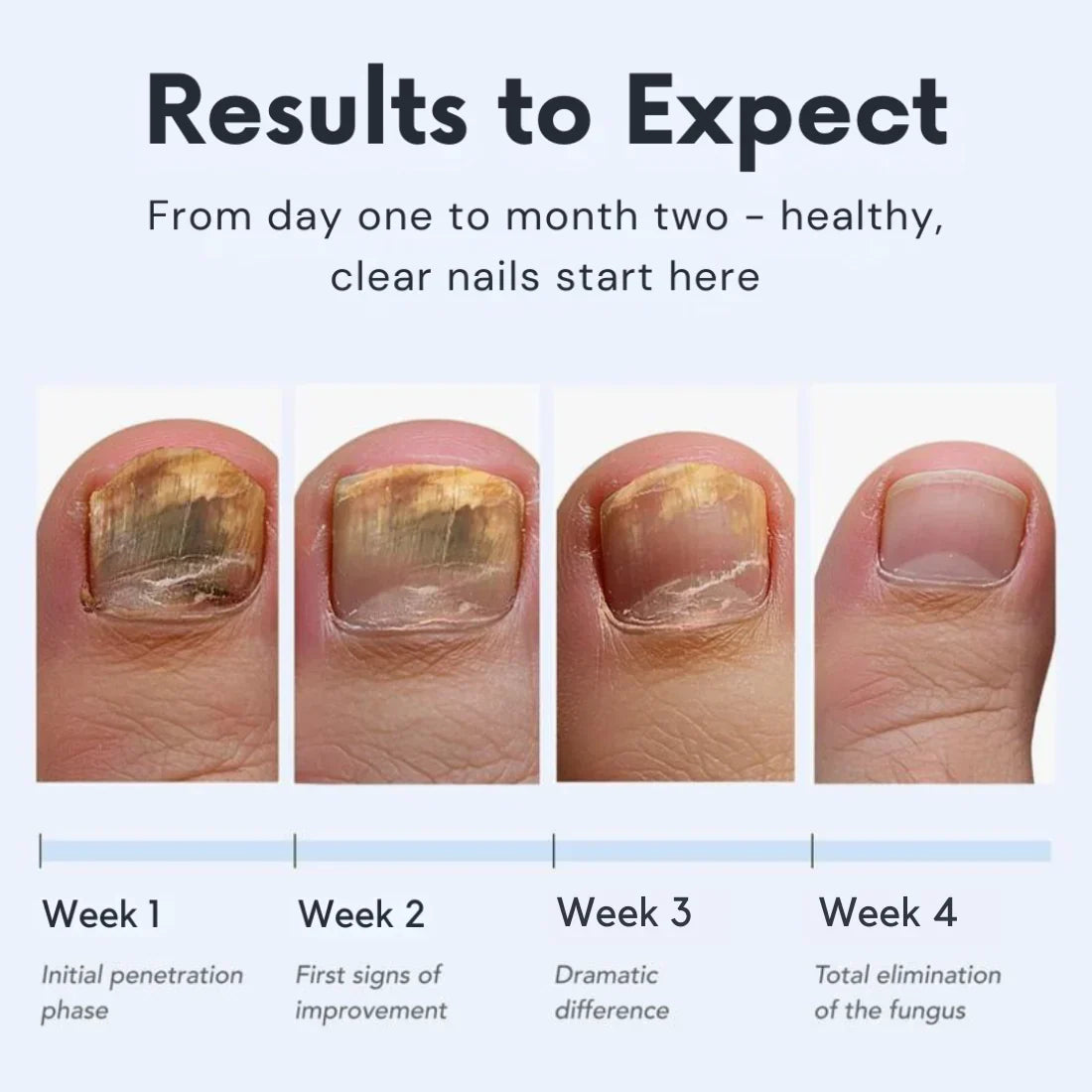 Lumiieren™ Antifungal Pen